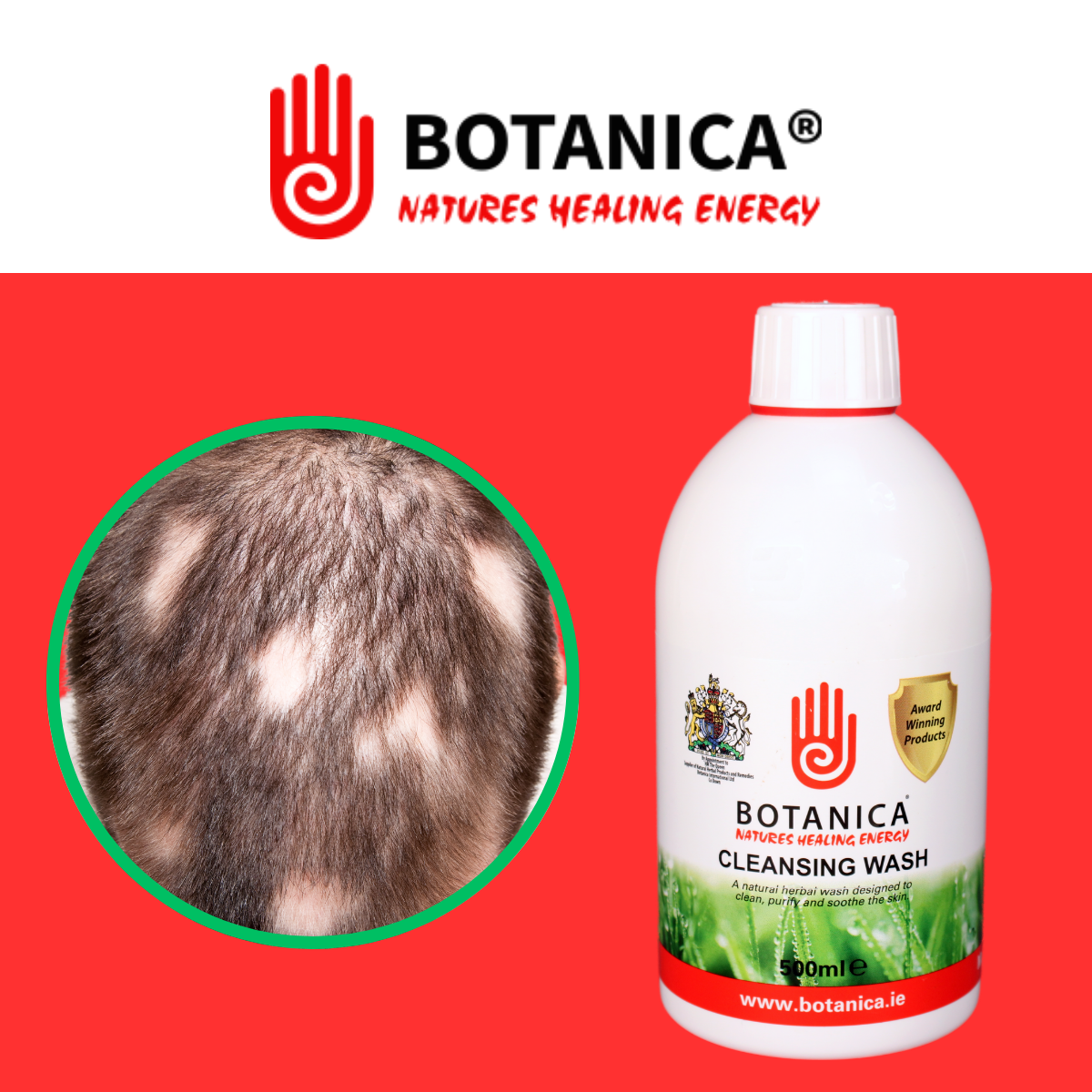 Support Alopecia Management