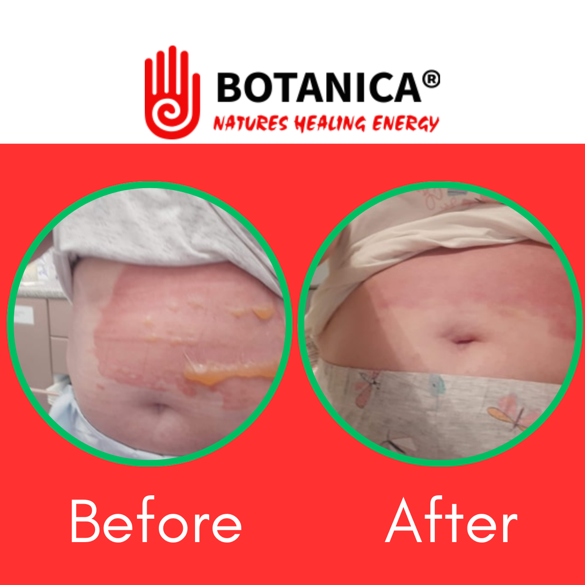 Soothe Burns and Scalds Naturally with Botanica Cream