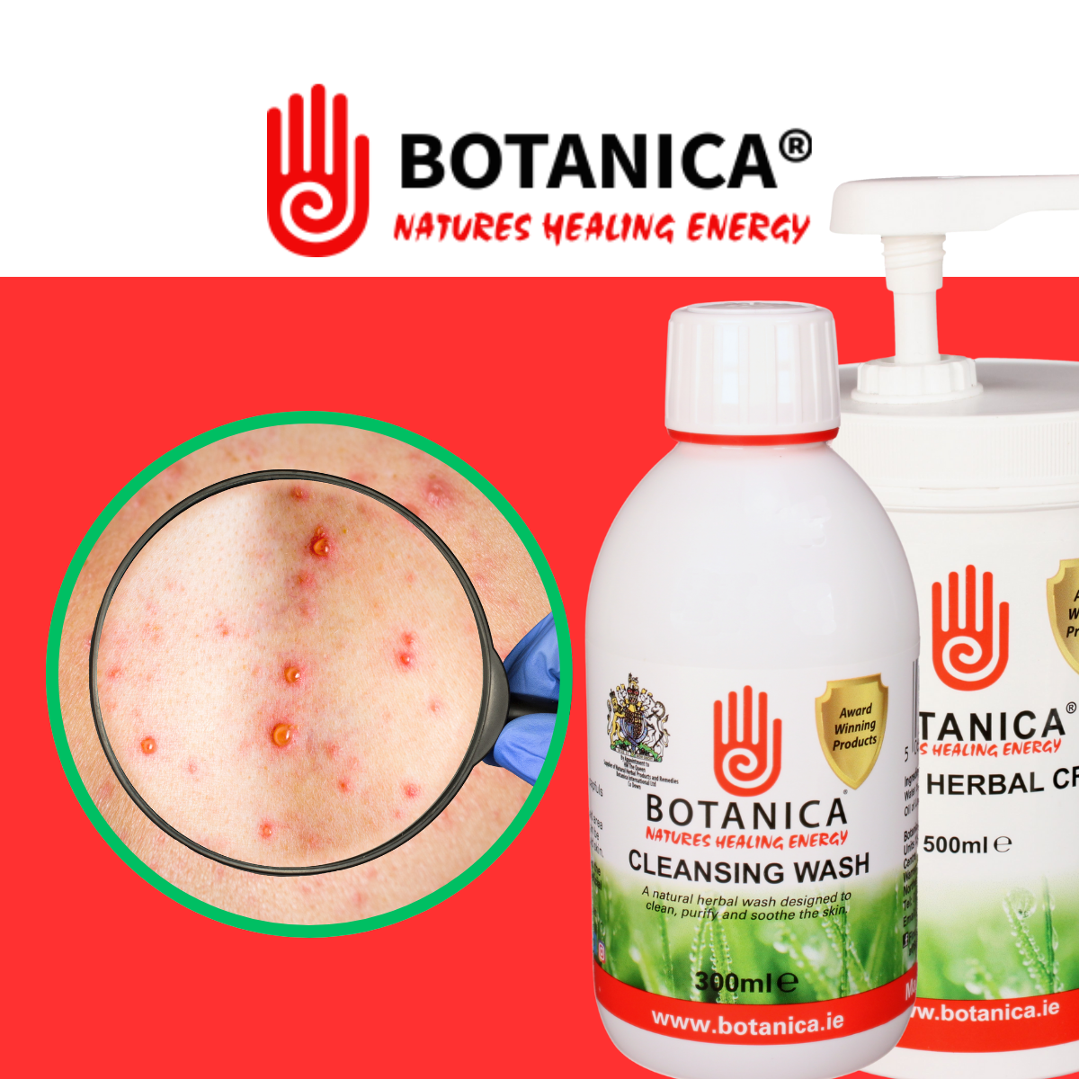 Soothe Chickenpox Symptoms with Botanica Wash Solution and Cream ...