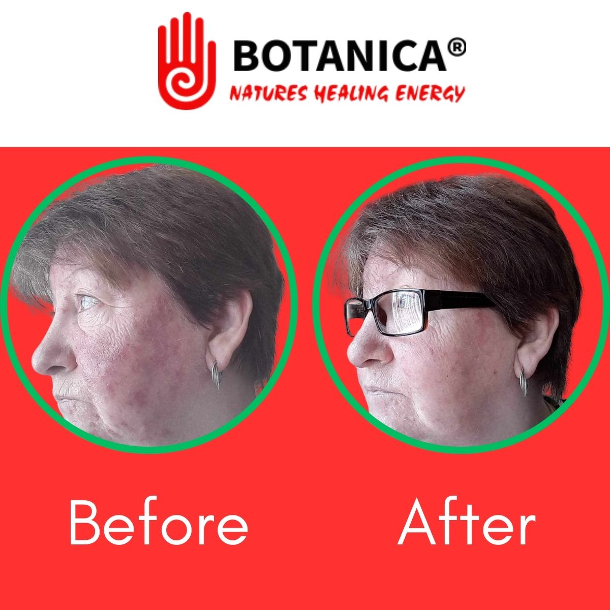 Managing Acne Rosacea with Botanica Wash Solution and Cream